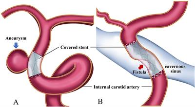 Use of covered stents to treat complex cerebrovascular diseases: Expert consensus